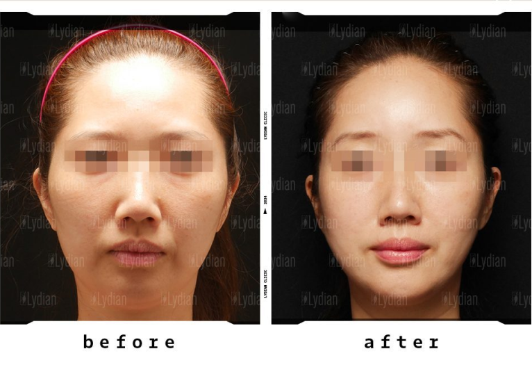 change of old looking face to youthful looking face after thread lifting