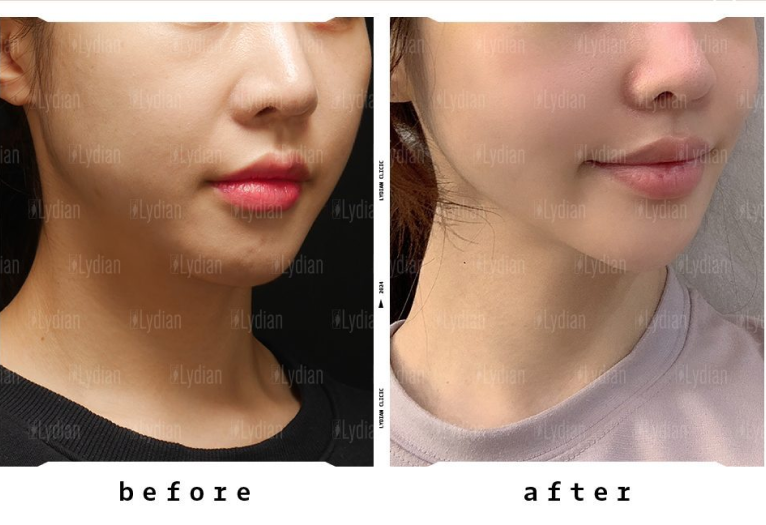 beautiful facial changes after thread lifting