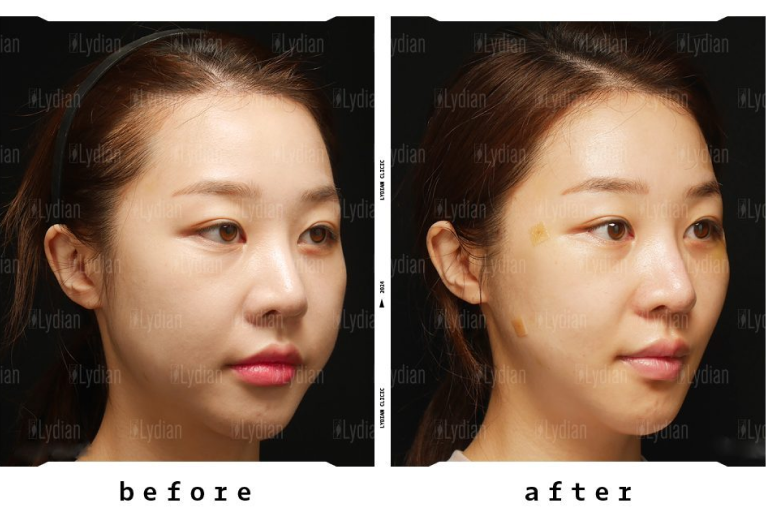 before and after facial transformation