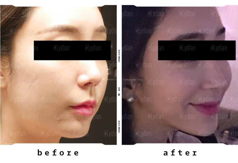 change of woman face to slim and youthful look