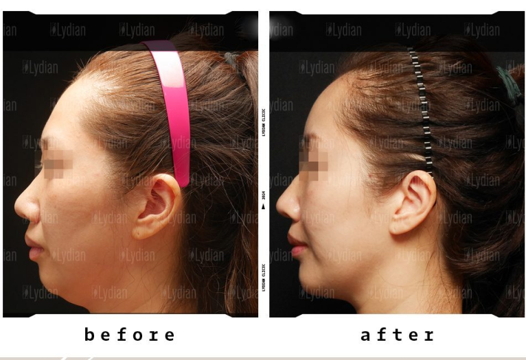 thread lifting before and after transformations