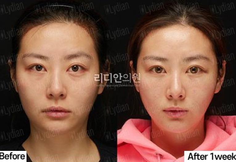 thread lifting before and after image of woman face