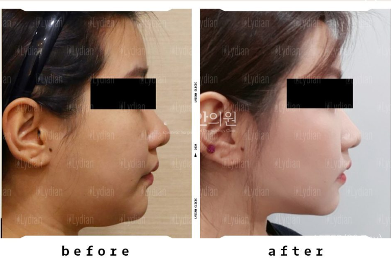 before and after facial images after thread lifting