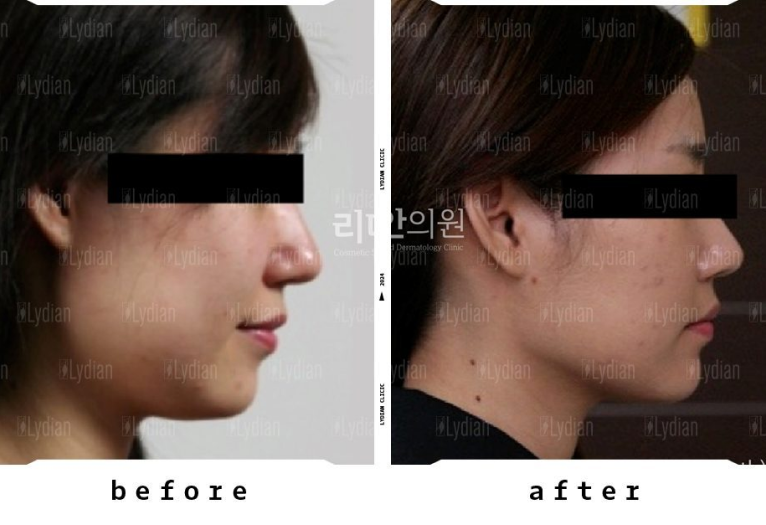 thread lifting before and after images