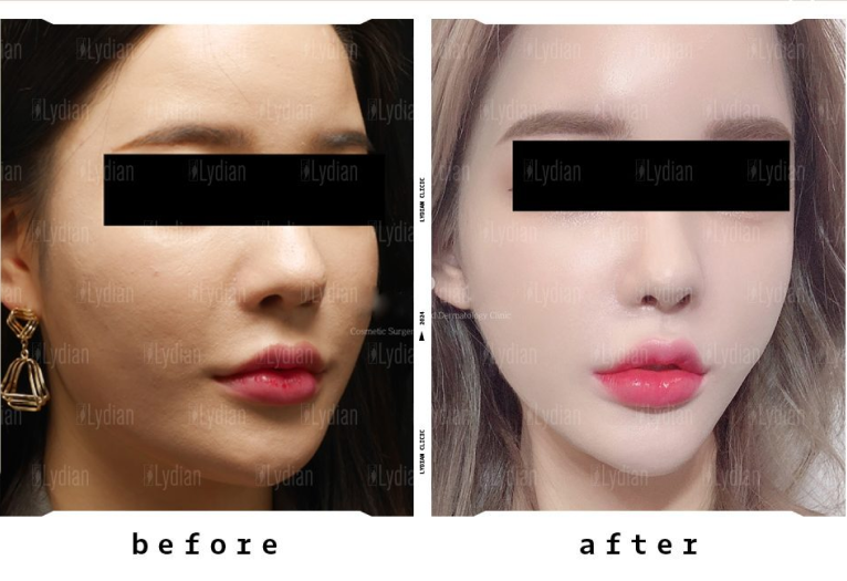 transformation of woman face from fat to slim after thread lifting