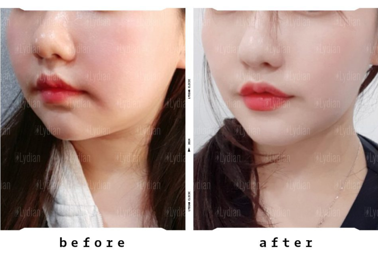 comparison of thread lifting before and after facial images