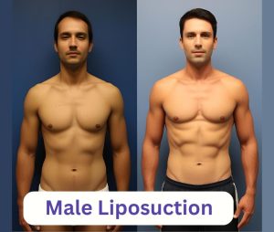 male liposuction before and after results