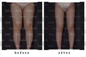 thigh liposuction