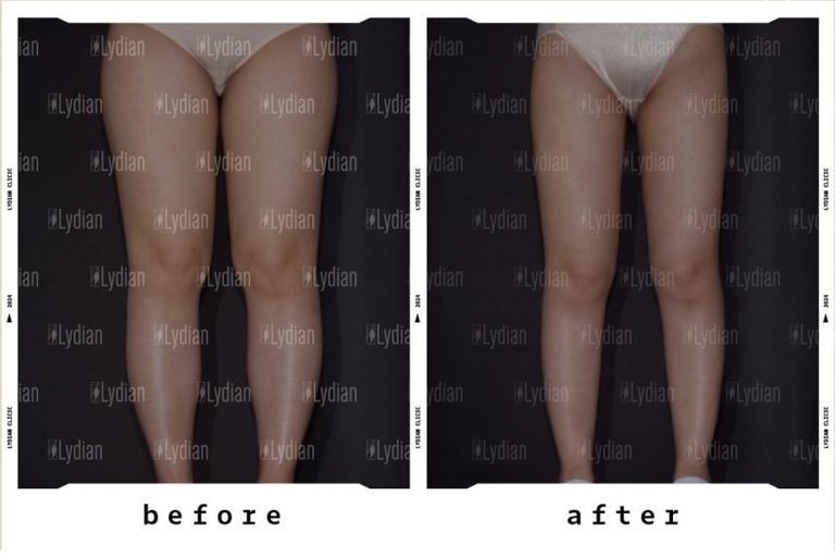 thigh liposuction