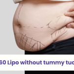 can you get 360 liposuction without tummy tuck