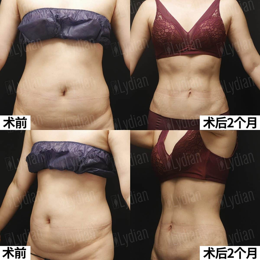 abdomen liposuction before and after results, real patient transformation