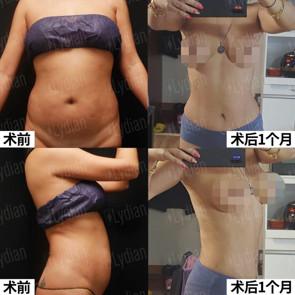 tummy tuck before and after results