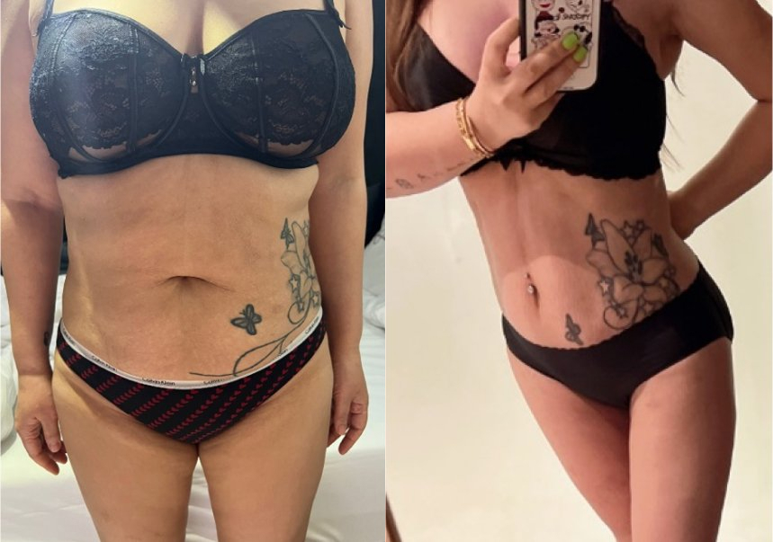 abdomen liposuction before and after results, real patient transformation