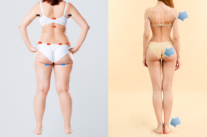 4D vs. 5D Liposculpture