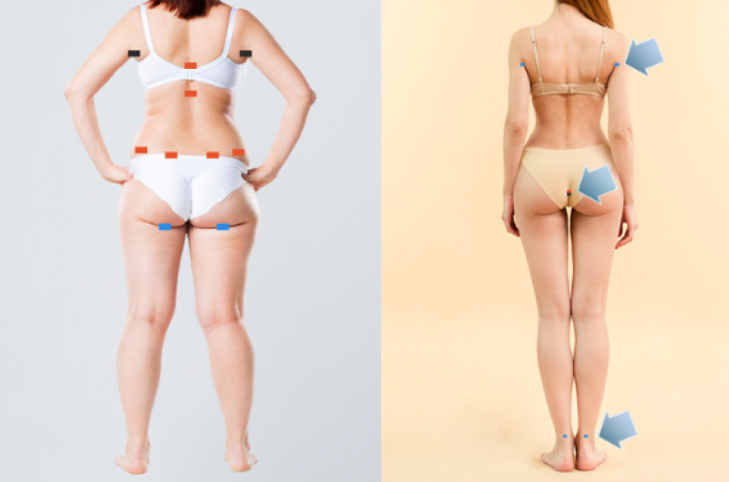 4D vs. 5D Liposculpture
