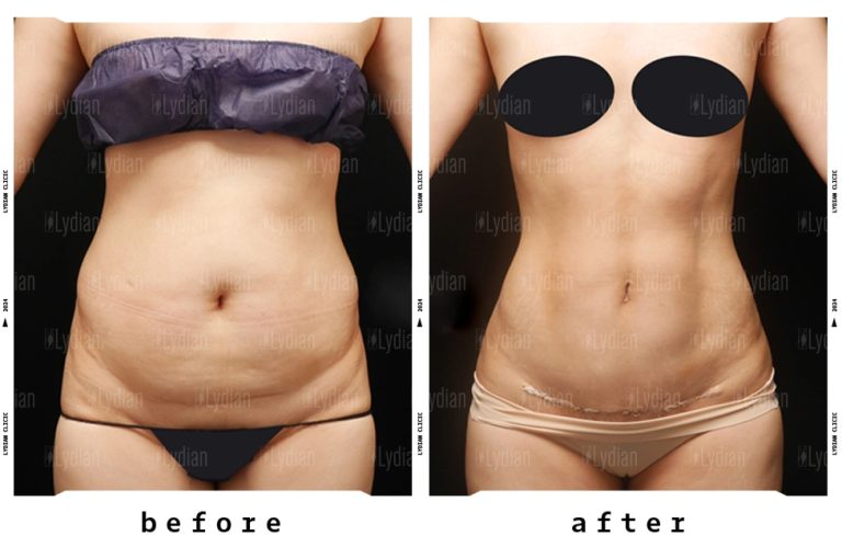 Tummy tuck transformation see the amazing progress