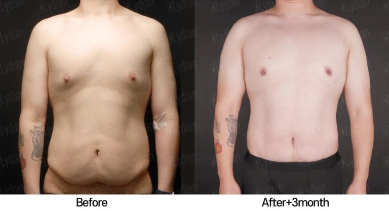 Healing and transformation a 3 month look at tummy tuck results