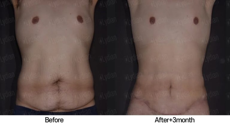 90 days post liposuction results the journey to a tighter toned midsection