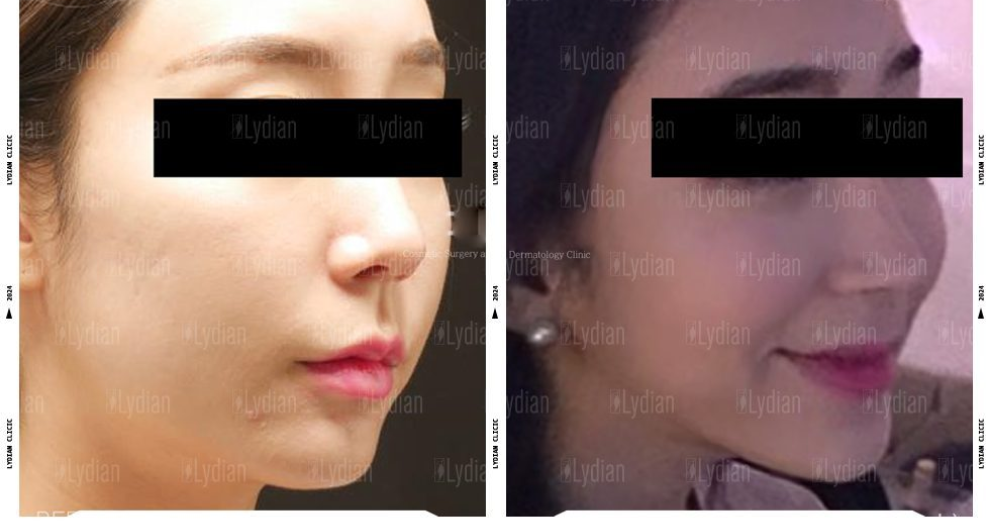 Facial Liposuction Before and After See the Stunning Transformation