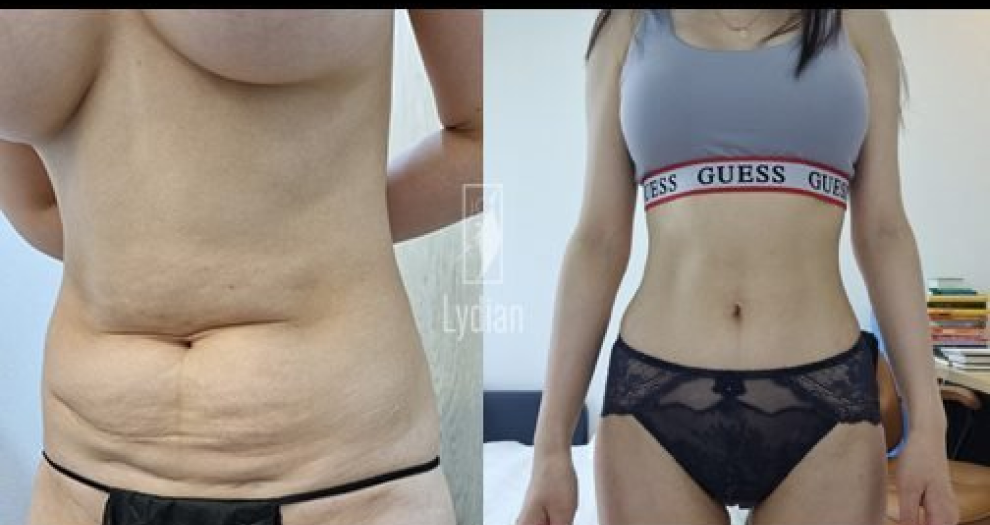 Revision Liposuction Before and After See the Improved Results