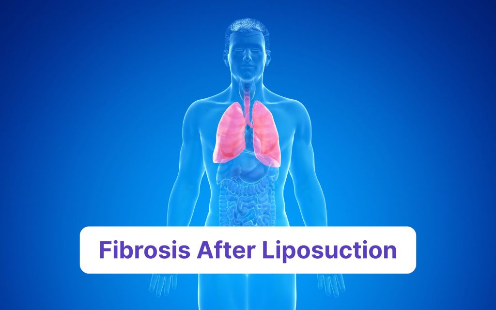 fibrosis on abdomen