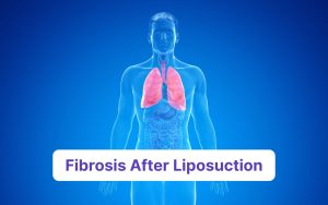 fibrosis on abdomen
