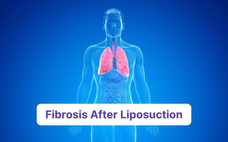 fibrosis on abdomen