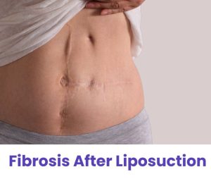 fibrosis after liposuction: causes, symptoms and treatments