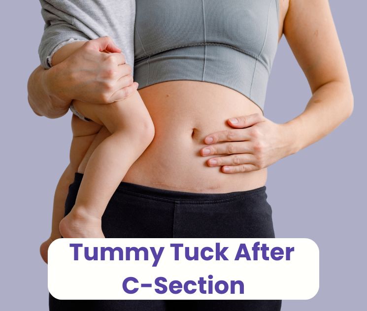 tummy tuck after c-section
