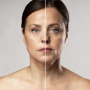 Fat Grafting vs. Fillers