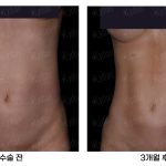 Body Sculpting
