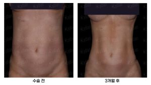 Body Sculpting