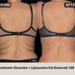 Before and after Renuvion liposuction removing 500cc of stubborn abdominal fat at Lydian Clinic in Korea