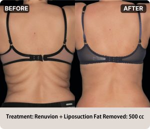 Before and after Renuvion liposuction removing 500cc of stubborn abdominal fat at Lydian Clinic in Korea