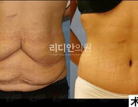 tummy tuck before and after results