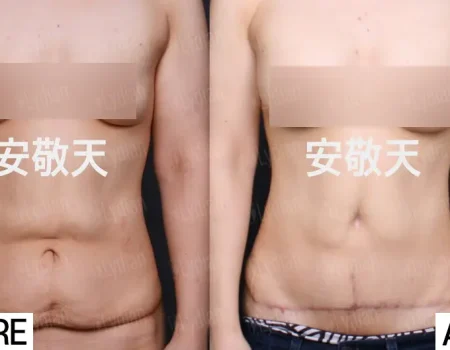 Before & After Breast Augmentation – Real Patient Results