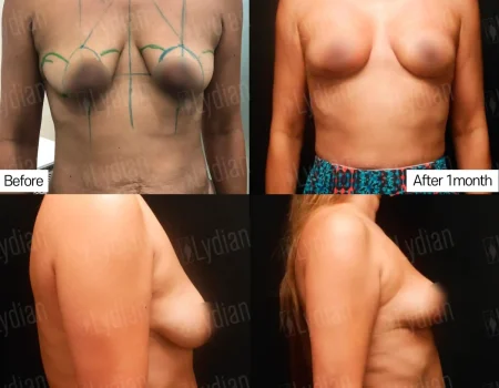 Breast Augmentation: Before & After Stunning Transformations