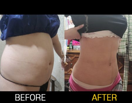 Before and After Revision Liposuction A Second Chance at Sculpted Perfection