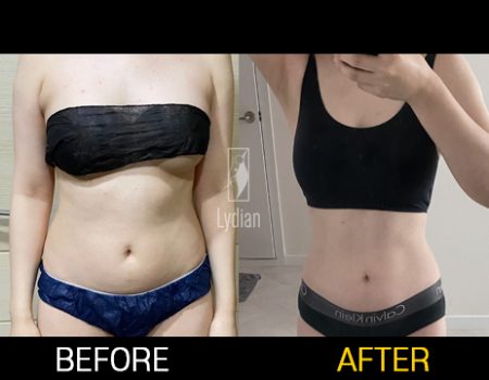 revision liposuction before and after transformation