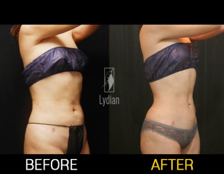 Revision Liposuction Results Witness the Difference