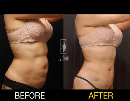Before and After Revision Liposuction Achieve a More Refined Look