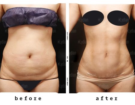 Tummy tuck transformation see the amazing progress