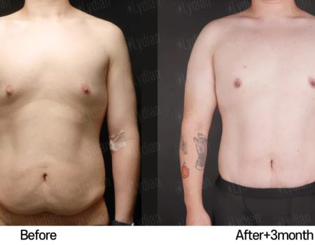 Healing and transformation a 3 month look at tummy tuck results