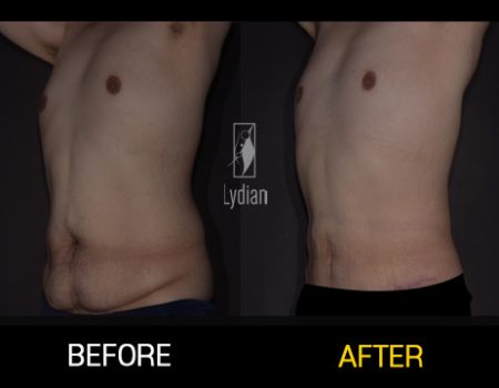 Healing and transformation look at tummy tuck results