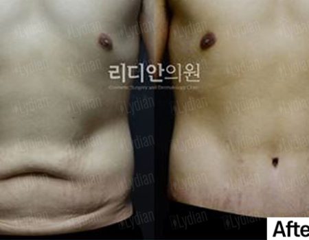 3 months post tummy tuck a flatter more sculpted abdomen revealed