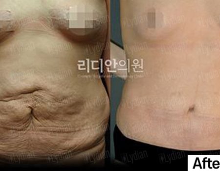 before and after 3 months tummy transformation following tummy tuck procedure