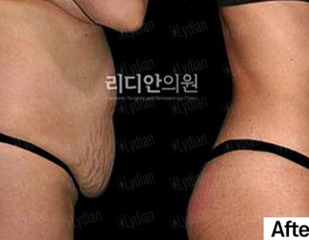 Before and after witness the dramatic 3 month tummy tuck journey