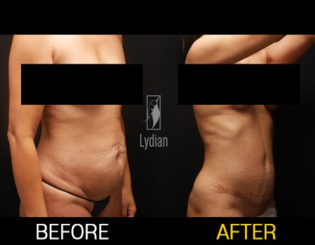 tummy before and after results following tummy tuck at lydian clinic