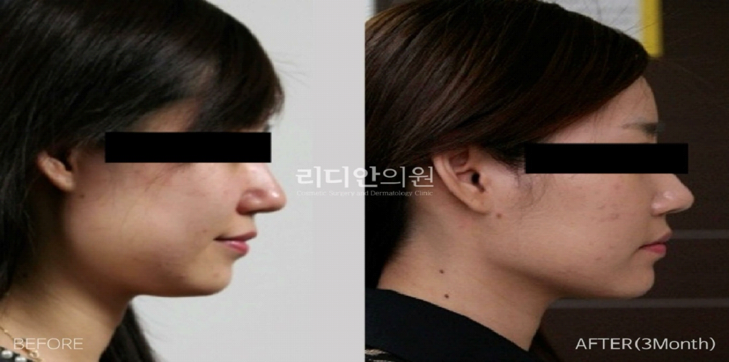 chin-liposuction