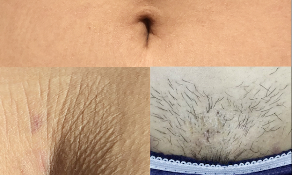liposuction thighs scars
